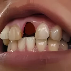 avulsed teeth