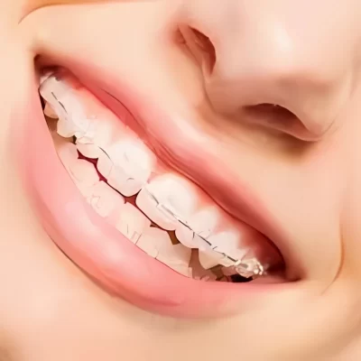 ceramic braces