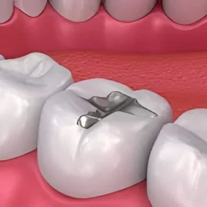 dental fillings