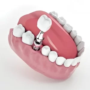 dental implants in coimbatore