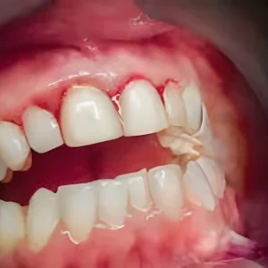 gum diseases