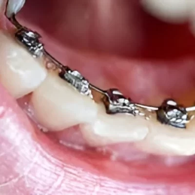 lingual braces