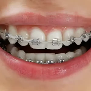 orthodontic braces