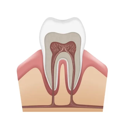 root canal treatment