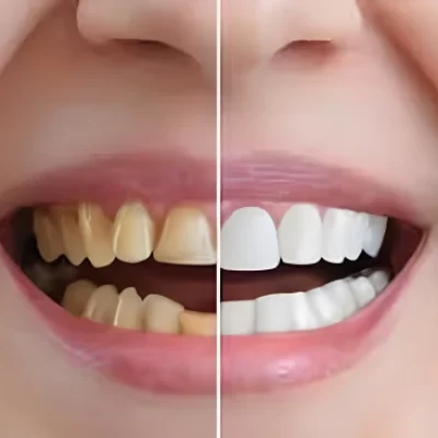 smile makeover