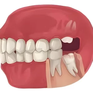 wisdom tooth extraction